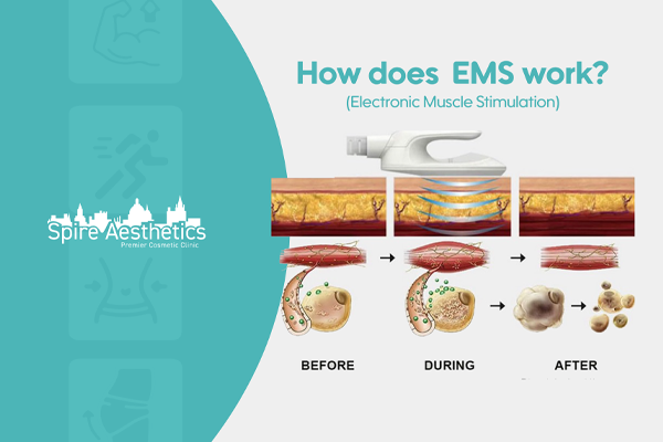 EMS treatment for post pregnancy weight loss treatment Tamworth