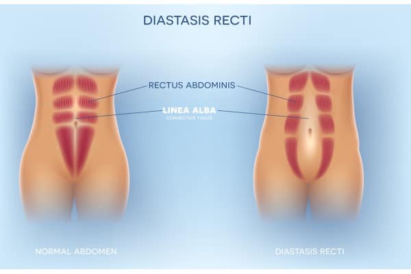 What Non-Surgical Options Are Available for Diastasis Recti Tamworth?