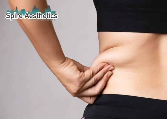 Image of woman pinching fat on their hips Tamworth. Fat Freezing treatment