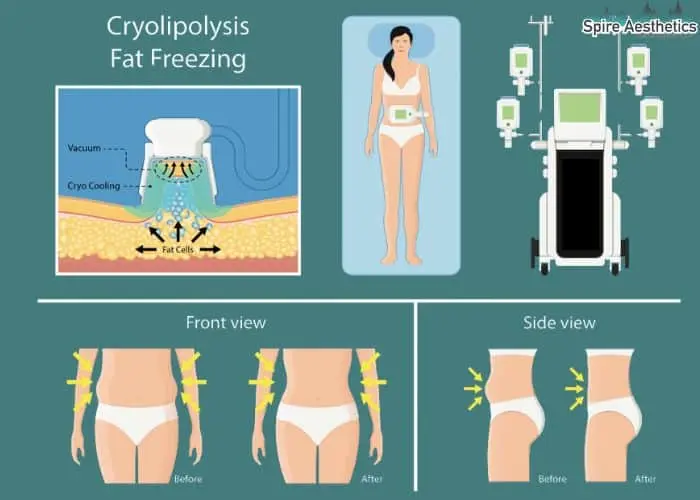 Fat freezing treatment Tamworth benefits for competitions to remove stubborn fat deposits.