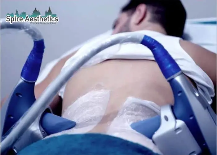 Man having fat freezing treatment done on love handles before a competitions Tamworth to create a sculpted look.