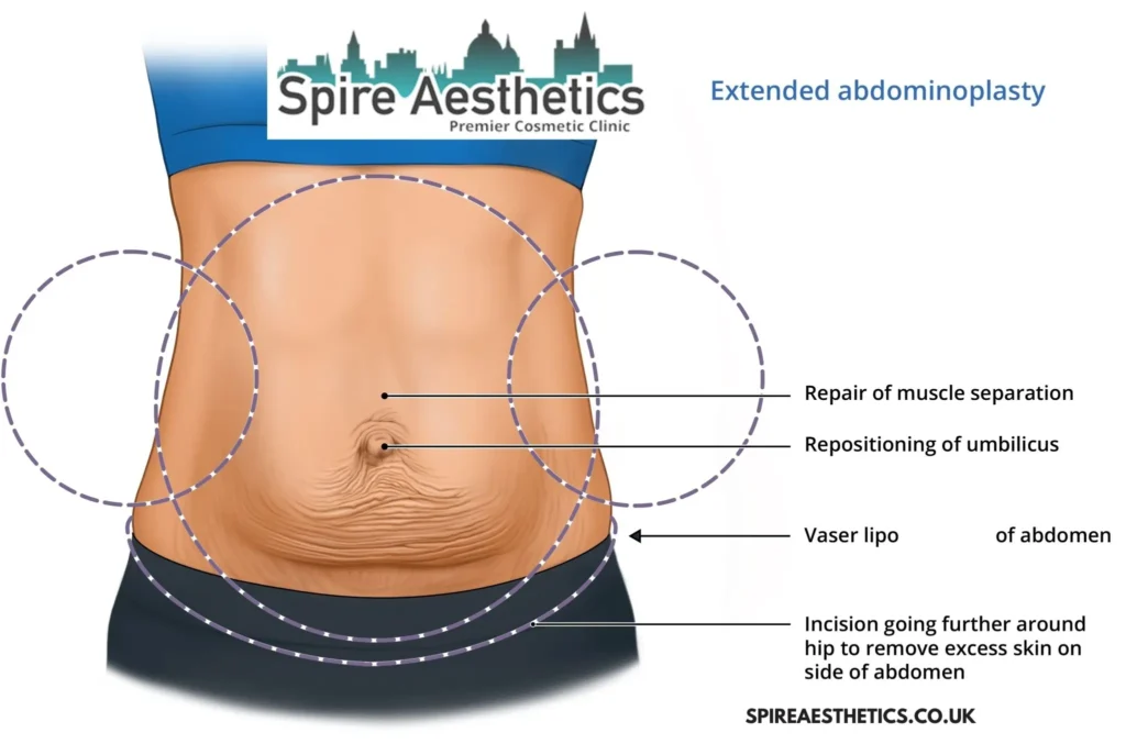 Understanding Loose Skin After Gastric Band Tamworth Surgery and HIFU Treatment