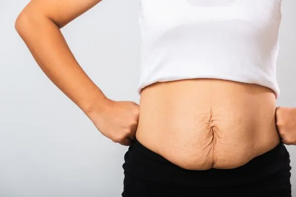 Image of a woman's stomach after weight loss with sagging skin following a gastric band Tamworth
