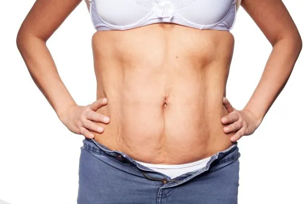 sagging skin on woman's stomach after weight loss injections Tamworth