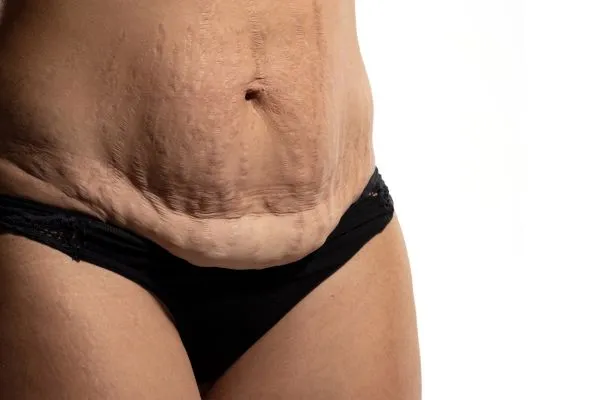 Image of womans stomach after weight loss injections Tamworth showing saggy skin