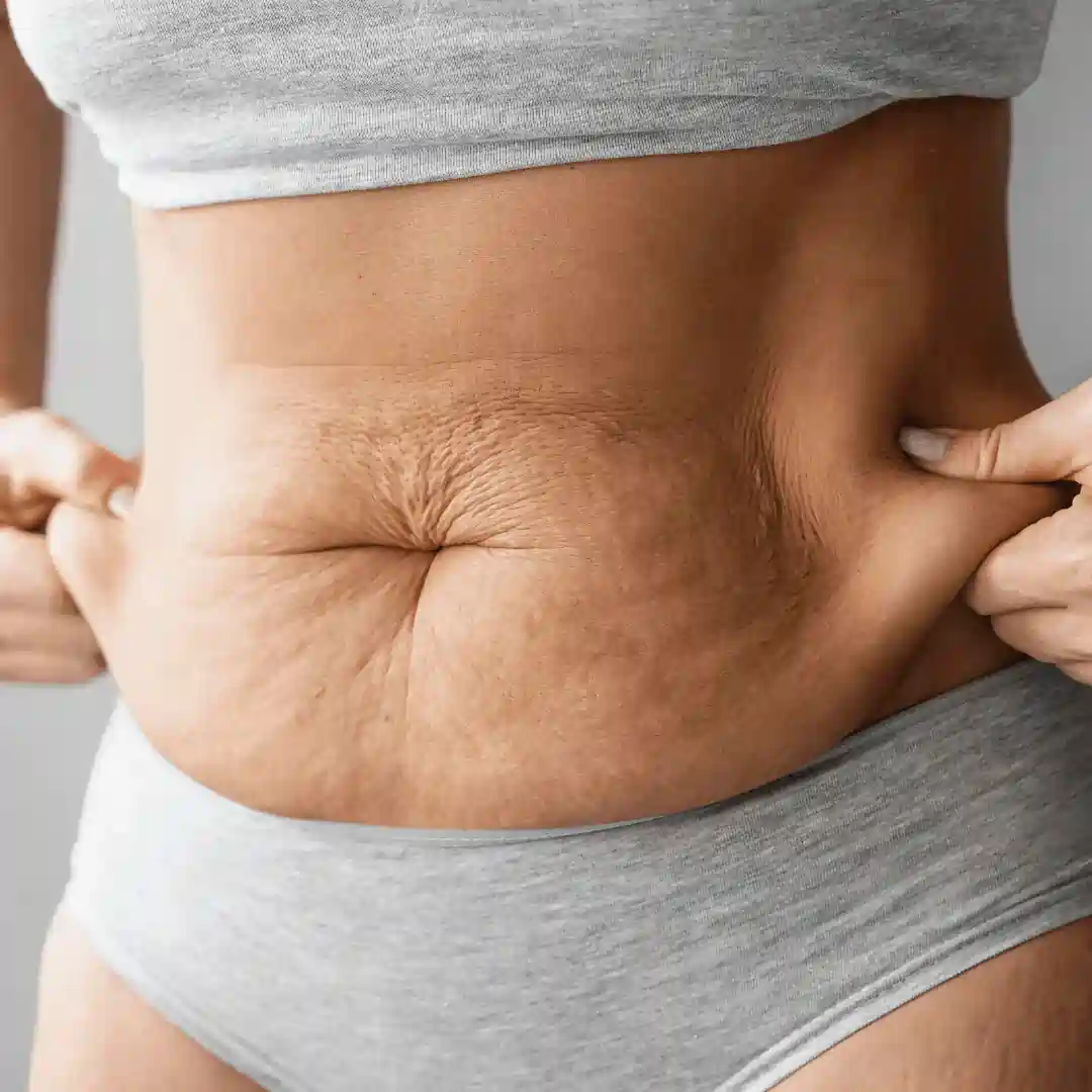 Is It Normal to Have Loose Skin After Pregnancy Tamworth?