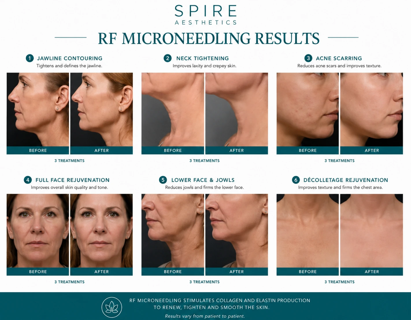 RF Microneedling Skin tightening Tamworth results