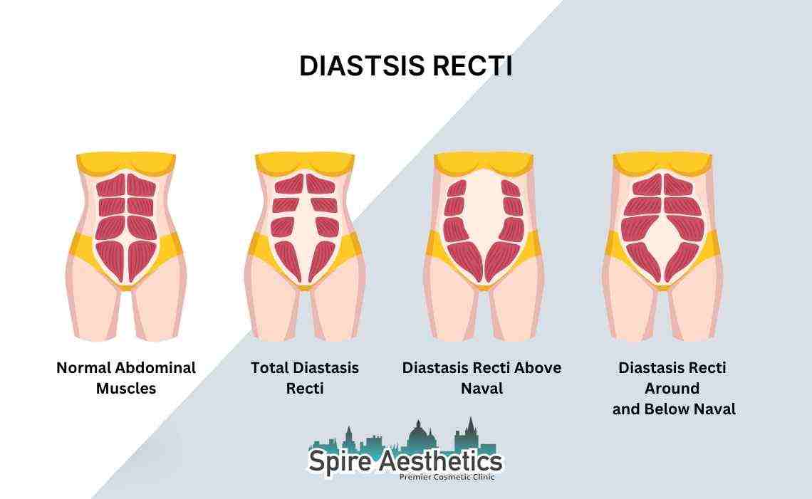 Is Non-Surgical Diastasis Recti Treatment Right for You? Common Concerns Answered Tamworth